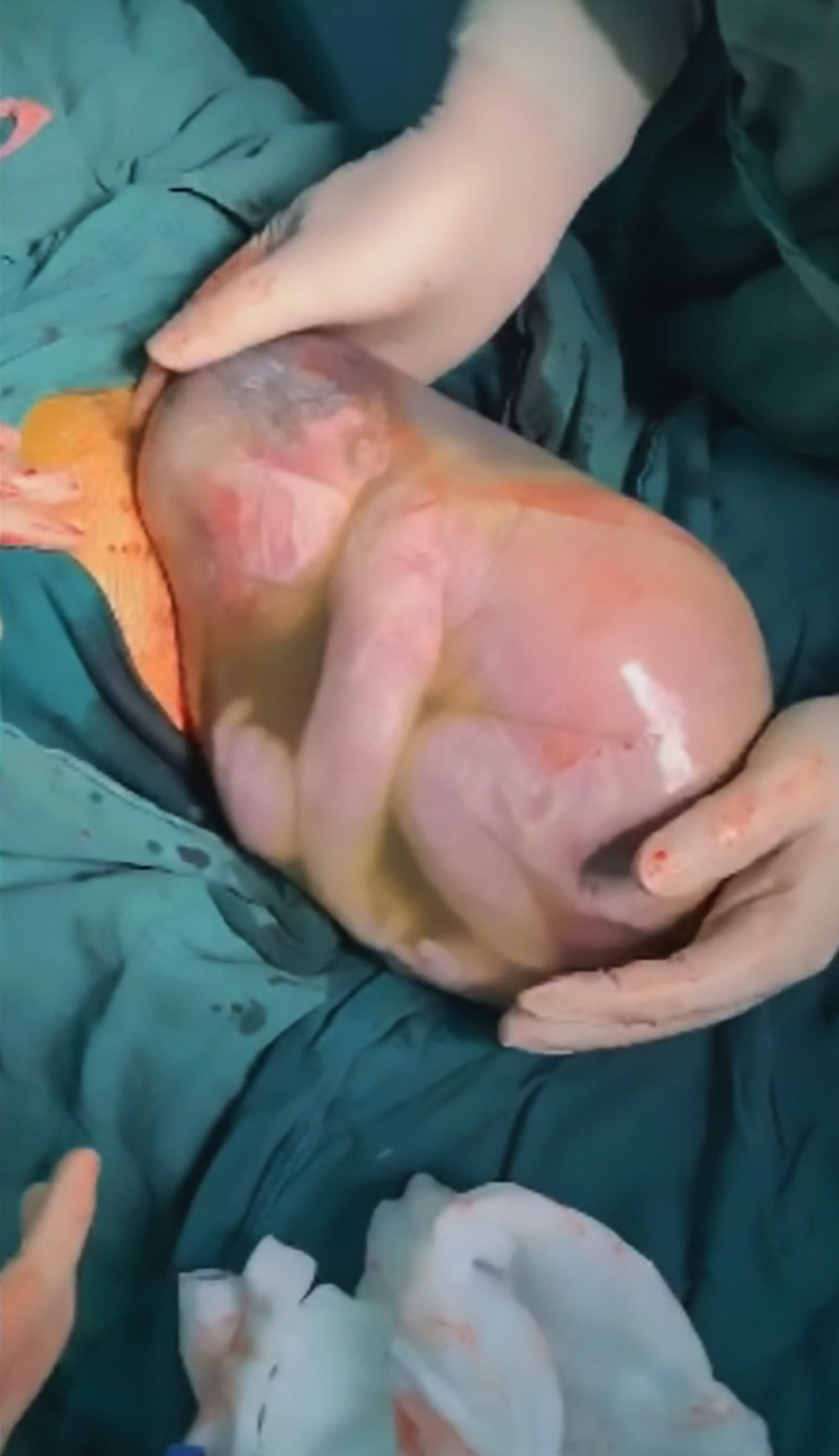 Amazing moment child is born while still inside Amniotic Sac